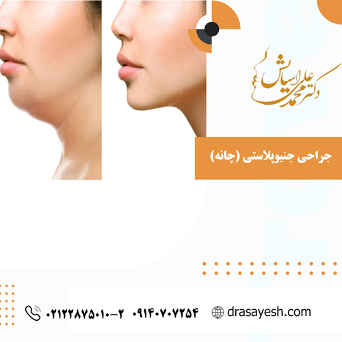 جراحی جنیوپلاستی (چانه)