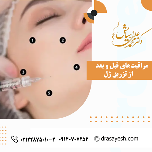 مراقبت‌های قبل و بعد از تزریق ژل