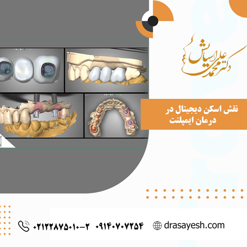 نقش اسکن دیجیتال در درمان ایمپلنت